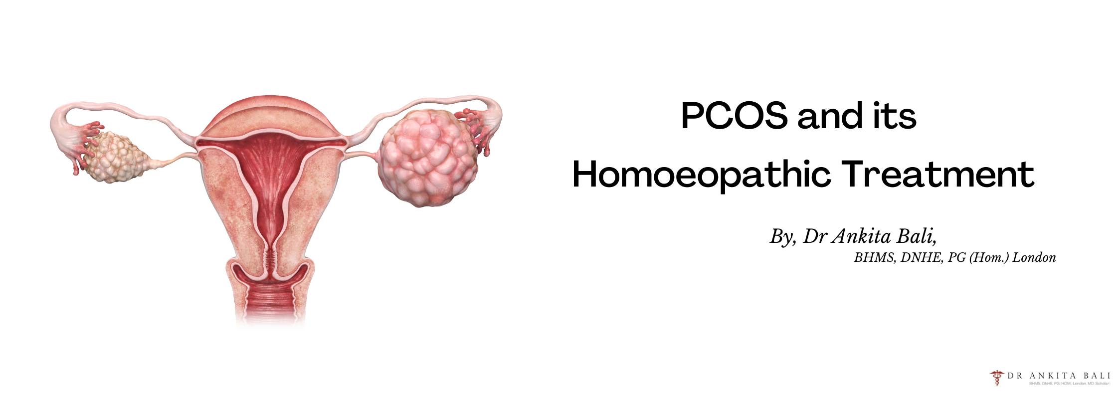 Copy of PCOS and its's Homoeopathic Treatment